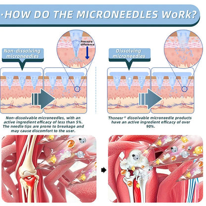 Official Store：👩‍⚕️Recommended by AAOS🏃‍♂️‍➡️AnnieCare® Nano-microneedle joint patch (Painless, long-lasting, suitable for arthritis, varicose veins and various orthopedic diseases)